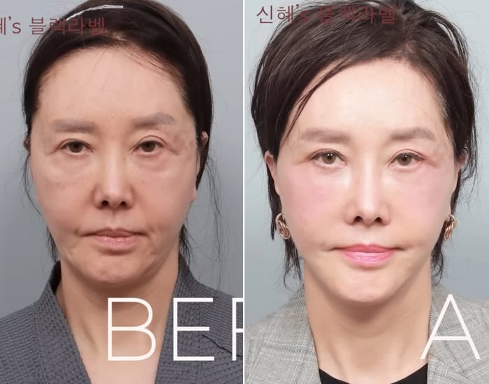 “못 알아볼 정도로 달라졌다” 유혜리, 62세에 공개한 안면거상 후 변화가 화제인 이유